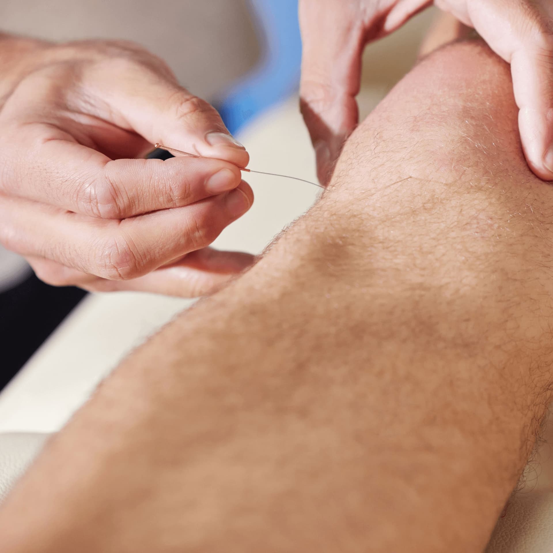 Therapist performing acupuncture therapy at an osteopathy and physiotherapy clinic